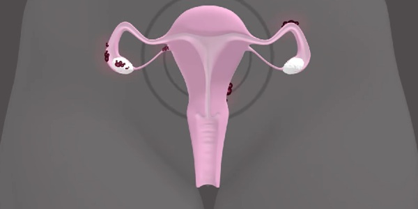508_endometriosis.jpg